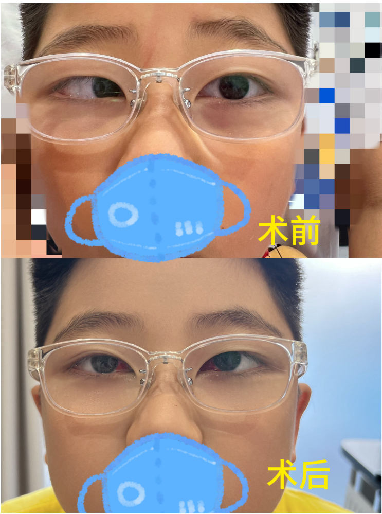 手术前后对比