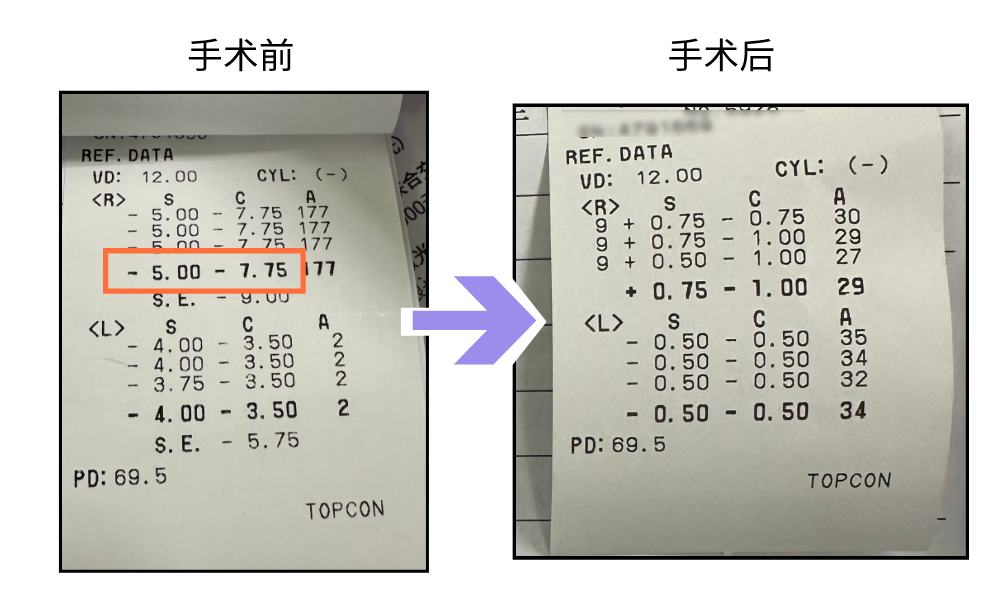 手术前后的视力表