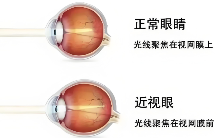 上海和平眼科|老花与近视会互抵？答案和你想的不一样...