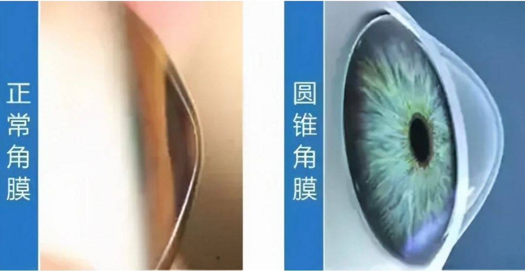 角膜