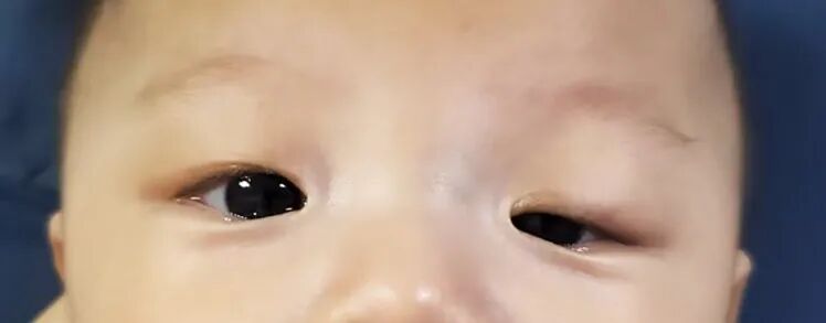 厦门眼科中心|1岁宝宝眼睛睁不开，竟是先天“大小眼”！医生：上睑下垂这样看......