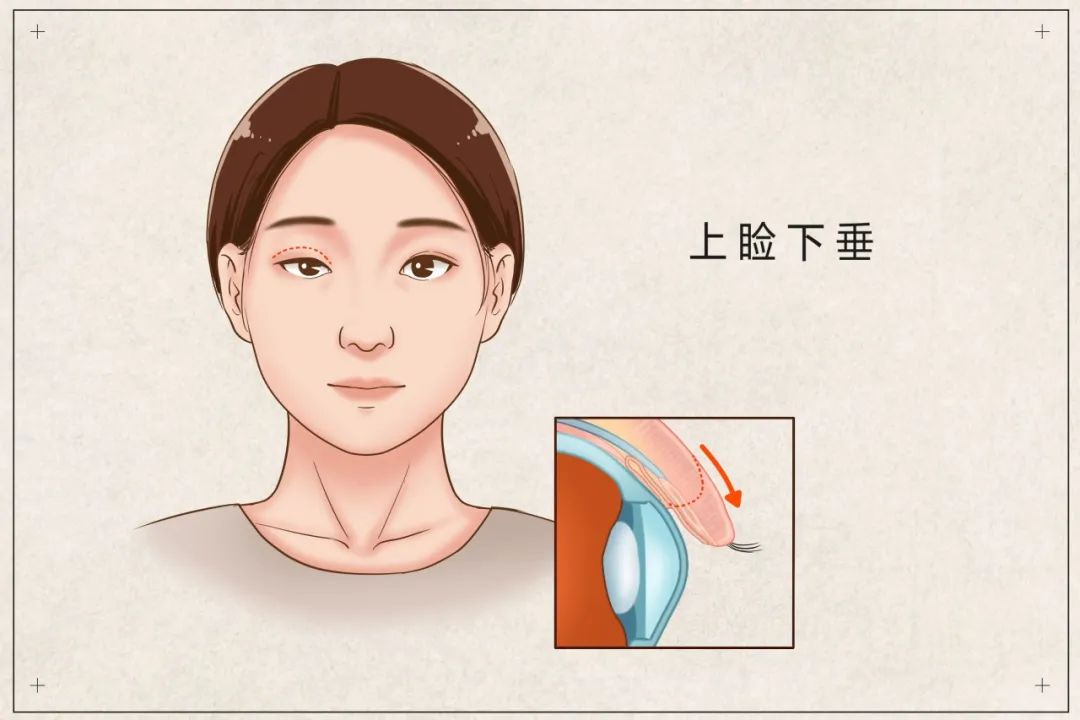 上睑下垂