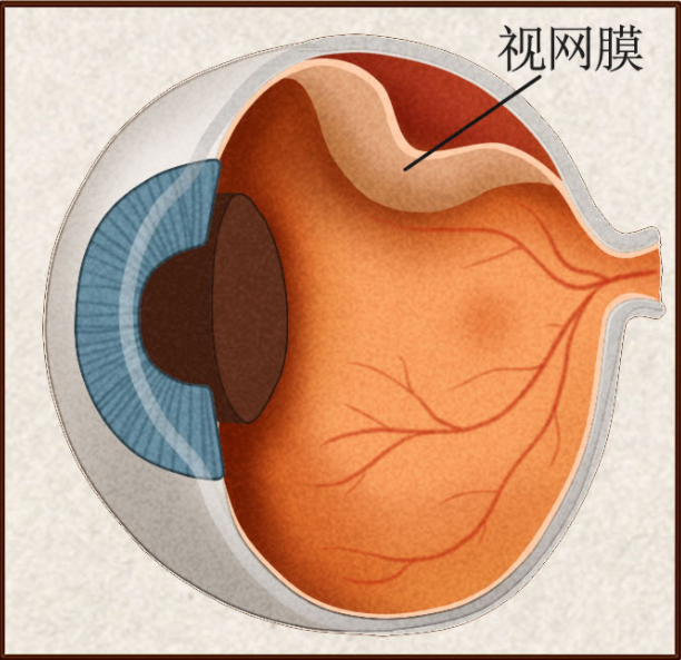 视网膜脱离