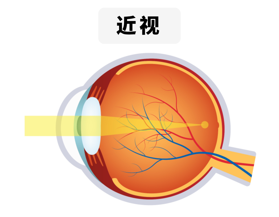近视