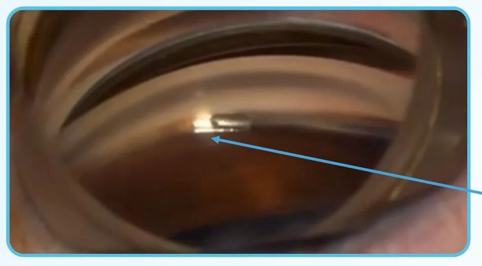将Hydrus微支架熟练植入眼内天然引流通道