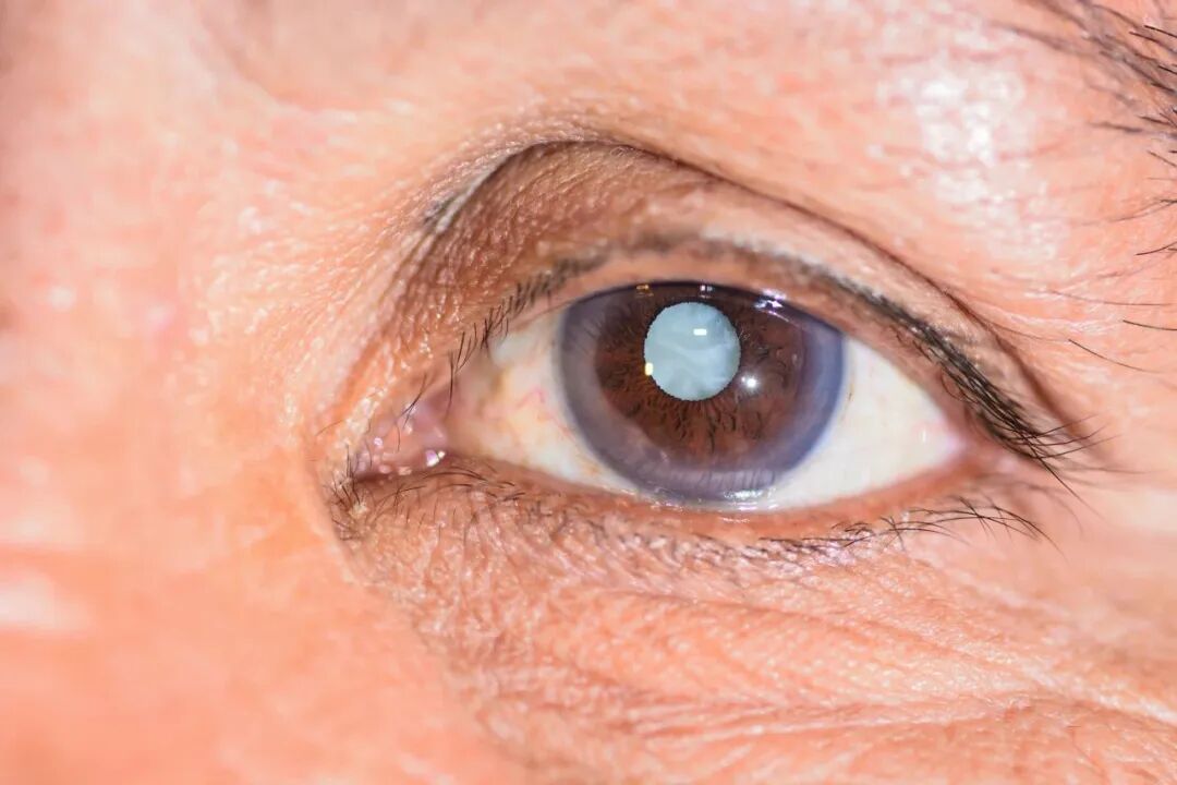 上海和平眼科|白内障只有老年人会得？白内障要等“熟了”再摘？这些误区不要再信了！