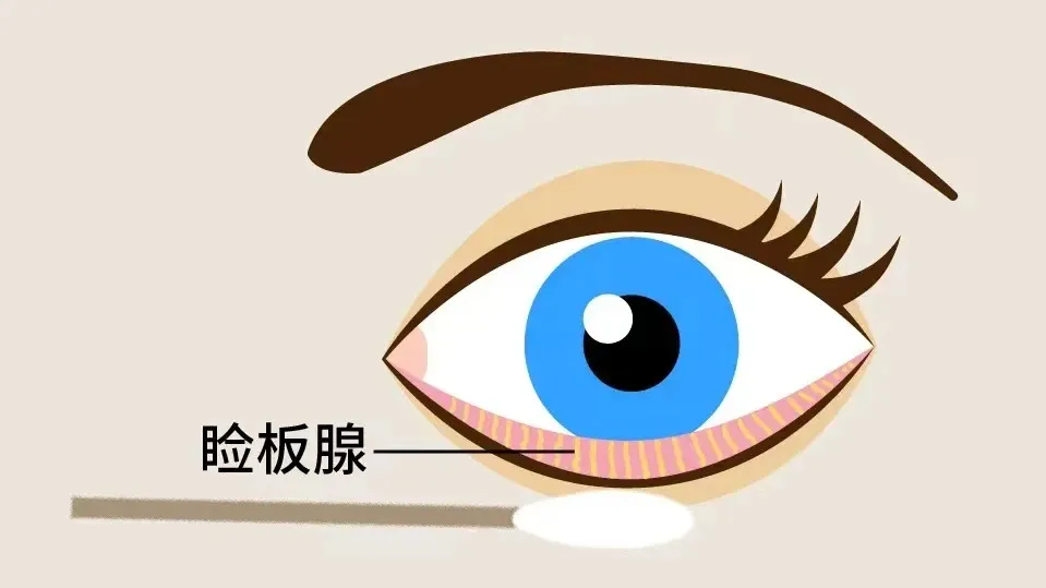 睑板腺