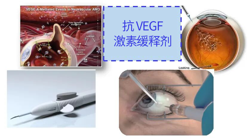 图4 眼内注射示意图