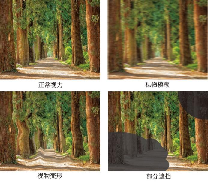 图3 视力障碍示意图