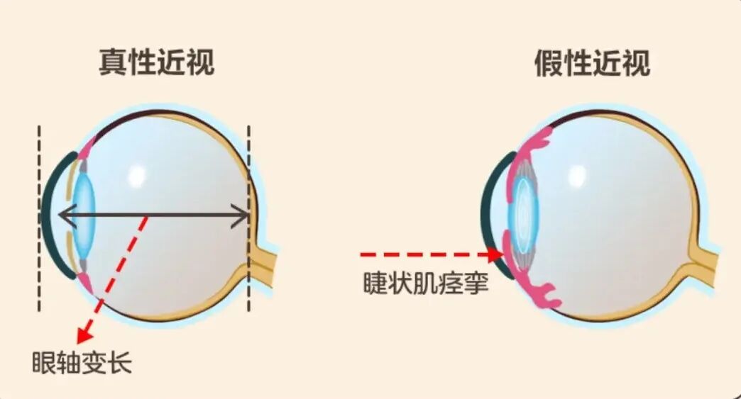 真假近视