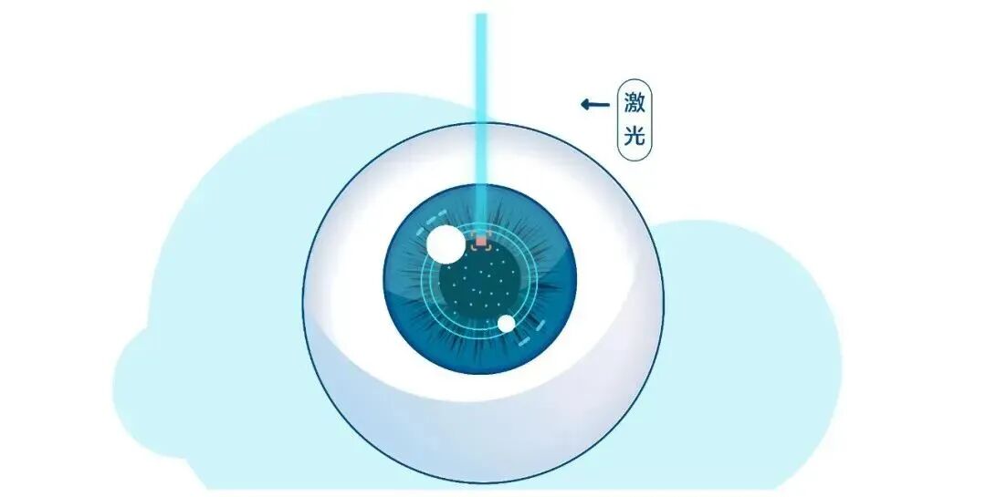 上海和平眼科 | 好纠结啊，想做近视手术，到底选激光，还是ICL？