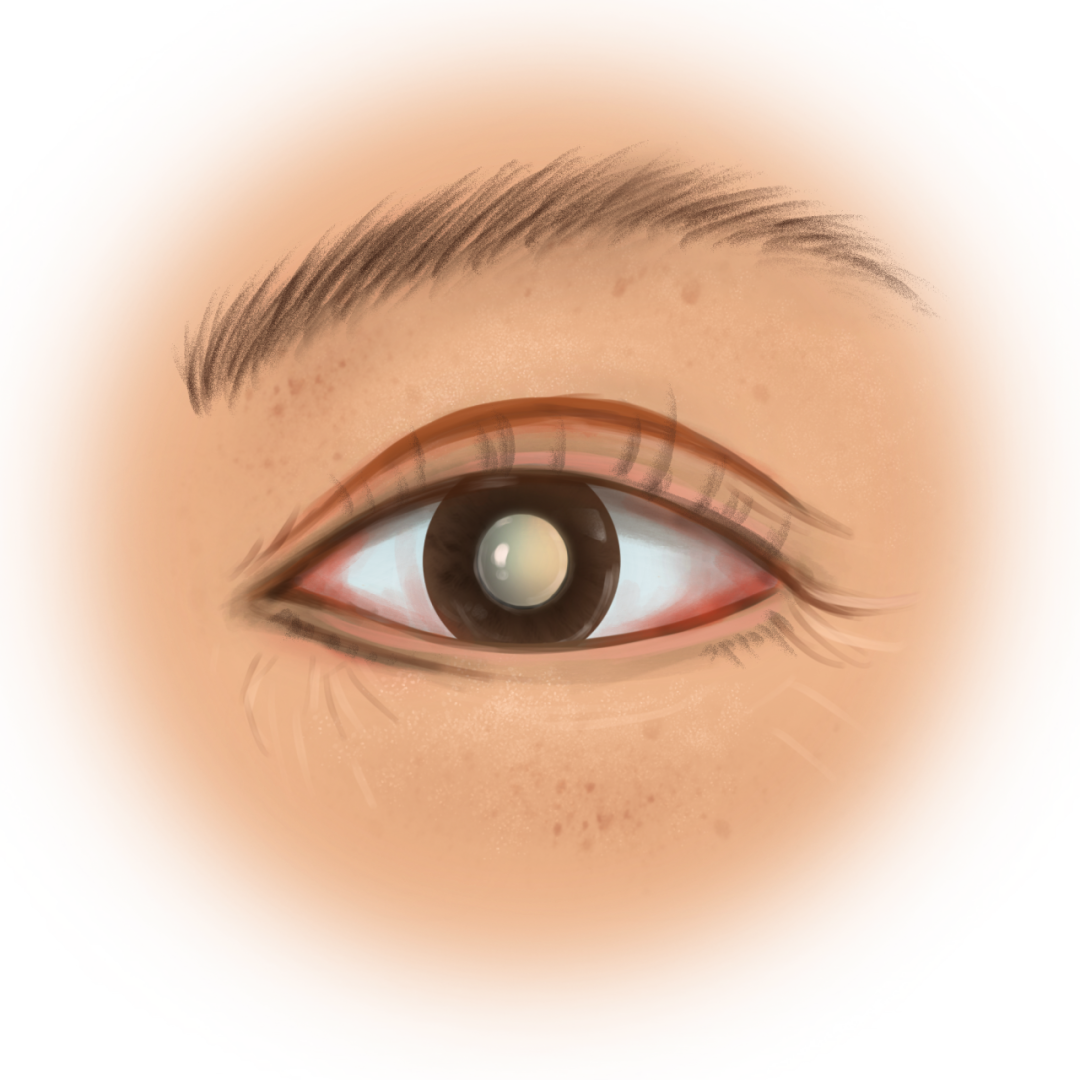 上海和平眼科| 越贵越好？白内障人工晶状体怎么选？一文说清