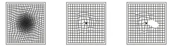 黄斑病变会产生的样子